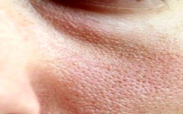  چطور می توانیم منافذ باز پوست را از بین ببریم؟
 