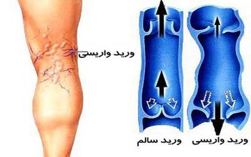 راهکارهای طبیعی برای درمان واریس