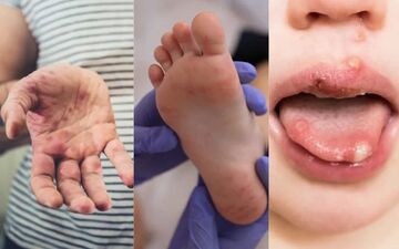 تب برفکی انسان: ویروس مسری و خطرات آن برای کودکان و بزرگسالان
