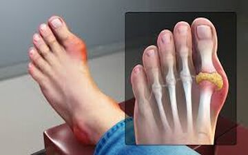 چه عواملی نقرس را بدتر می کند؟