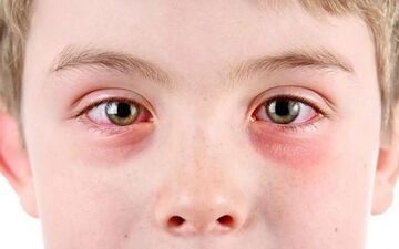 چگونه از شر آلرژی چشمی خلاص شویم؟ 