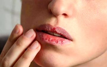 علت خشکی دهان و ۹ راهکار برای برطرف کردن آن