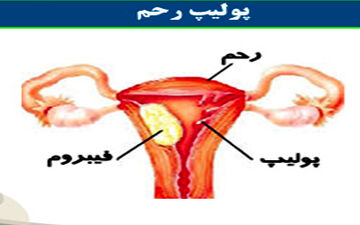 پولیپ رحم چیست؟علائم پولیپ رحم چیست؟