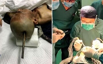 زنده ماندن مردی که میلگرد در جمجمه اش فرو رفت! +عکس های باورنکردنی