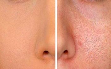 میخوای از شر منافذ باز پوستت خلاص بشی؟ اینجا رو بخون