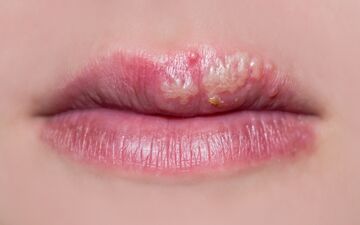 تبخال را سه دقیقه ای ناپدید کنید