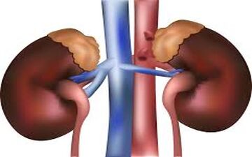 علت دفع پروتئین در ادرار چیست؟ چه بیمارانی دچار دفع پروتئین در ادرار هستند؟چگونه درمان می‌شود؟