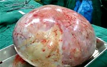 توده چهار و نیم کیلویی از شکم یک بانوی 18 ساله در میناب هرمزگان خارج شد