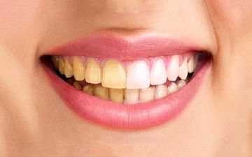  چرا رنگ دندانم تغییر کرد؟