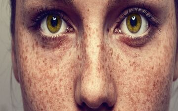 تشخیص کک‌و‌مک، لکه‌های آفتابی و خال: نکات کلیدی برای سلامت پوست