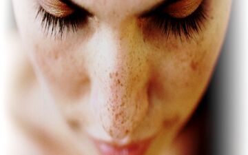 شایع‌ ترین دلیل بروز لک پوستی