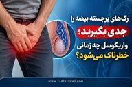 رگ‌های برجسته بیضه را جدی بگیرید؛ واریکوسل چه زمانی خطرناک می‌شود؟
