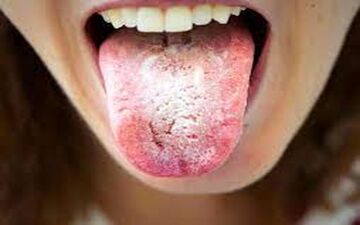 چه چیزی باعث سفید شدن زبان می‌شود؟