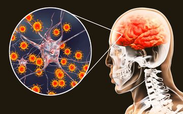 آنسفالیت خودایمنی؛ بیماری نادری که می‌تواند رفتار، حافظه و هوشیاری را تغییر دهد