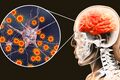 آنسفالیت خودایمنی؛ بیماری نادری که می‌تواند رفتار، حافظه و هوشیاری را تغییر دهد