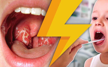 علائم ورم لوزه چیست؟