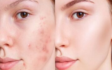 پنج ماده‌ای که به مبارزه با آکنه کمک می‌کند