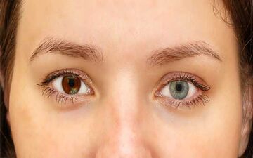 جراحی برای تغییر رنگ چشم؛ داشتن چشمان رنگی به چه قیمت؟