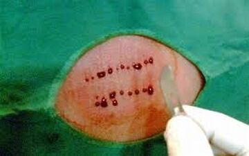 هر آنچه که لازم است درمورد حجامت بدانید!