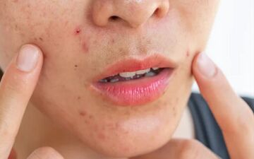 راهنمای سلامت پوست در بهار؛ از مدیریت استرس تا پاکسازی‌های تخصصی


