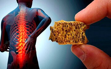 پوکی استخوان را چگونه درمان کنیم؟
