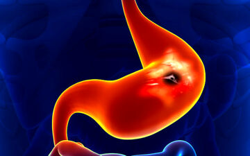 تشخیص سرطان مری و معده با آزمایش تنفس