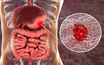 درمورد علائم گوارشی و غیر گوارشی رفلاکس چه می دانید؟