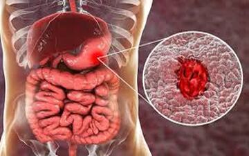 درمورد علائم گوارشی و غیر گوارشی رفلاکس چه می دانید؟