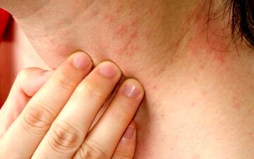 برای جلوگیری از عرق سوز شدن چه کنیم؟