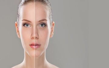 ماسک های خانگی معجزه کننده برای رفع جوش صورت