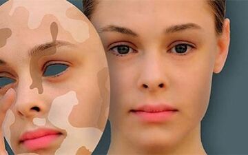 ویتیلیگو چیست و گریبانگیر چه کسانی می‌شود؟