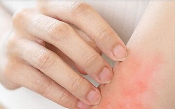 هنگام خارش ناشی از اگزما چکار باید کرد؟

