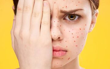 تفاوت بین آبله‌مرغان و زونا چیست؟ | آیا ممکن است کسی دو بار به آبله مرغان مبتلا شود؟