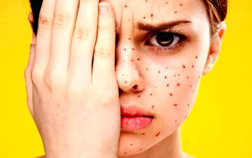 تفاوت بین آبله‌مرغان و زونا چیست؟ | آیا ممکن است کسی دو بار به آبله مرغان مبتلا شود؟
