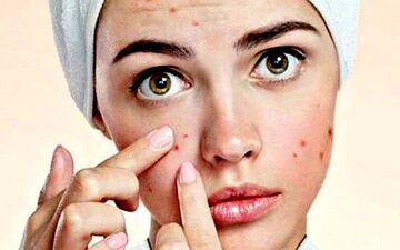 جوش صورت راچکار کنیم؟+ علل و راه‌های درمان 