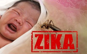 تاثیر ویروس زیکا بر کودک بعد از تولد


