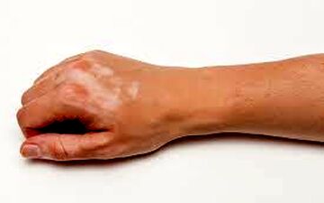 آشنایی با بیماری لک و پیس