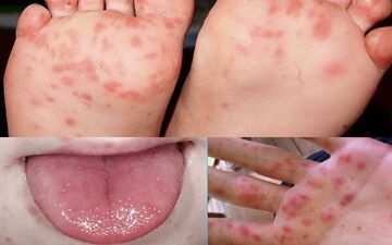 
چگونگی ابتلا به بیماری HFMD 