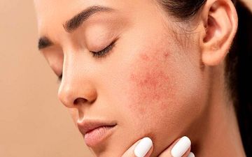 راهکارهایی برای جلوگیری از جوش زدن در بزرگسالی