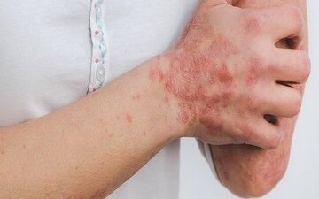 کرونا و مشکلاتی برای پوست