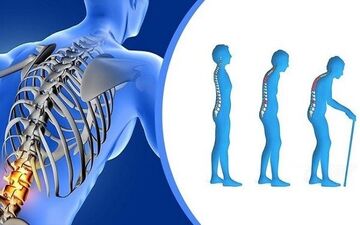 میتوان با پوکی استخوان ورزش کرد؟
