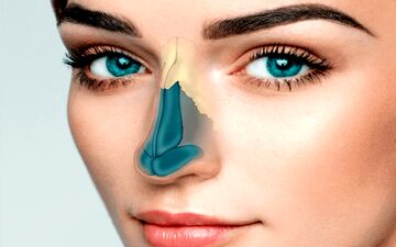 جراحی ترمیمی بینی کوتاه چگونه است؟