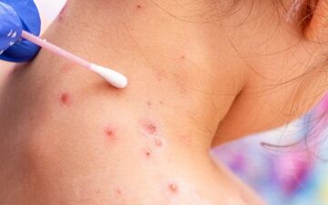 
آیا باید از آبله میمونی بترسی؟