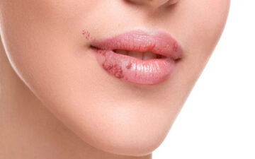 روش های  ساده و طبیعی برای درمان تبخال 