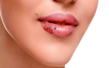 روش های  ساده و طبیعی برای درمان تبخال 