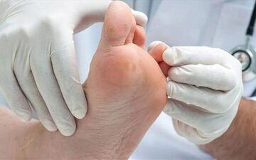 از چالش ها تا راهکارهای درمانی زخم پای دیابتی