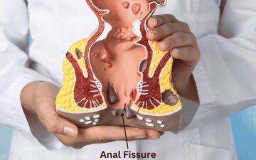شقاق مقعدی چیست؟ علائم، علل و روش‌های درمان آن را بشناسید