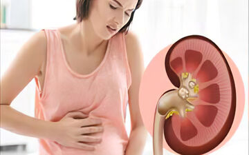 برای جلوگیری از ایجاد سنگ کلیه چه کنیم؟
