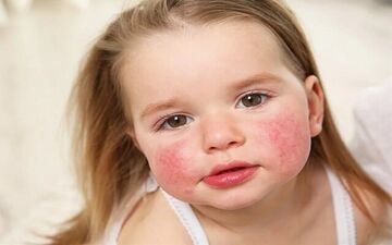 علائم هشداردهنده آلرژی غذایی در کودکان؛ نادیده نگیرید