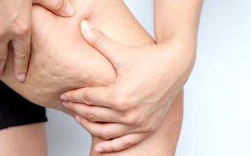 چگونه سلولیت را از بین ببریم؟| 3 روش ساده برای رفع سلولیت